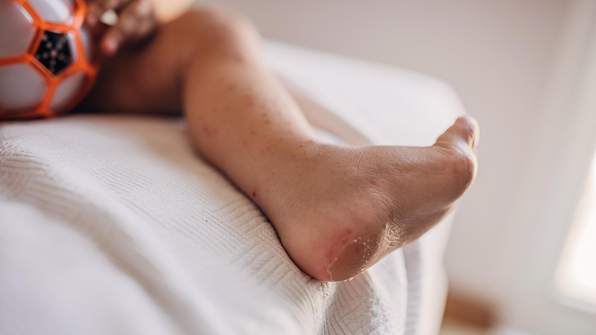 El Coxsackie, que provoca la Enfermedad Boca Mano Pie, es un virus que pertenece a la familia "Picornaviridae" (Foto: Archivo)