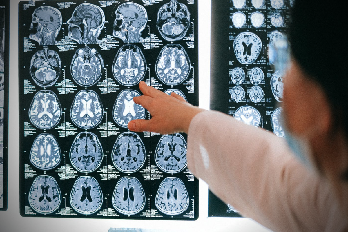 Las sinapsis son los puntos de contacto en el cerebro a través de los cuales las células nerviosas se comunican entre sí